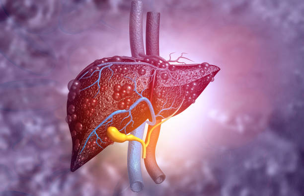AFLD- Alcoholic Fatty Liver Disease