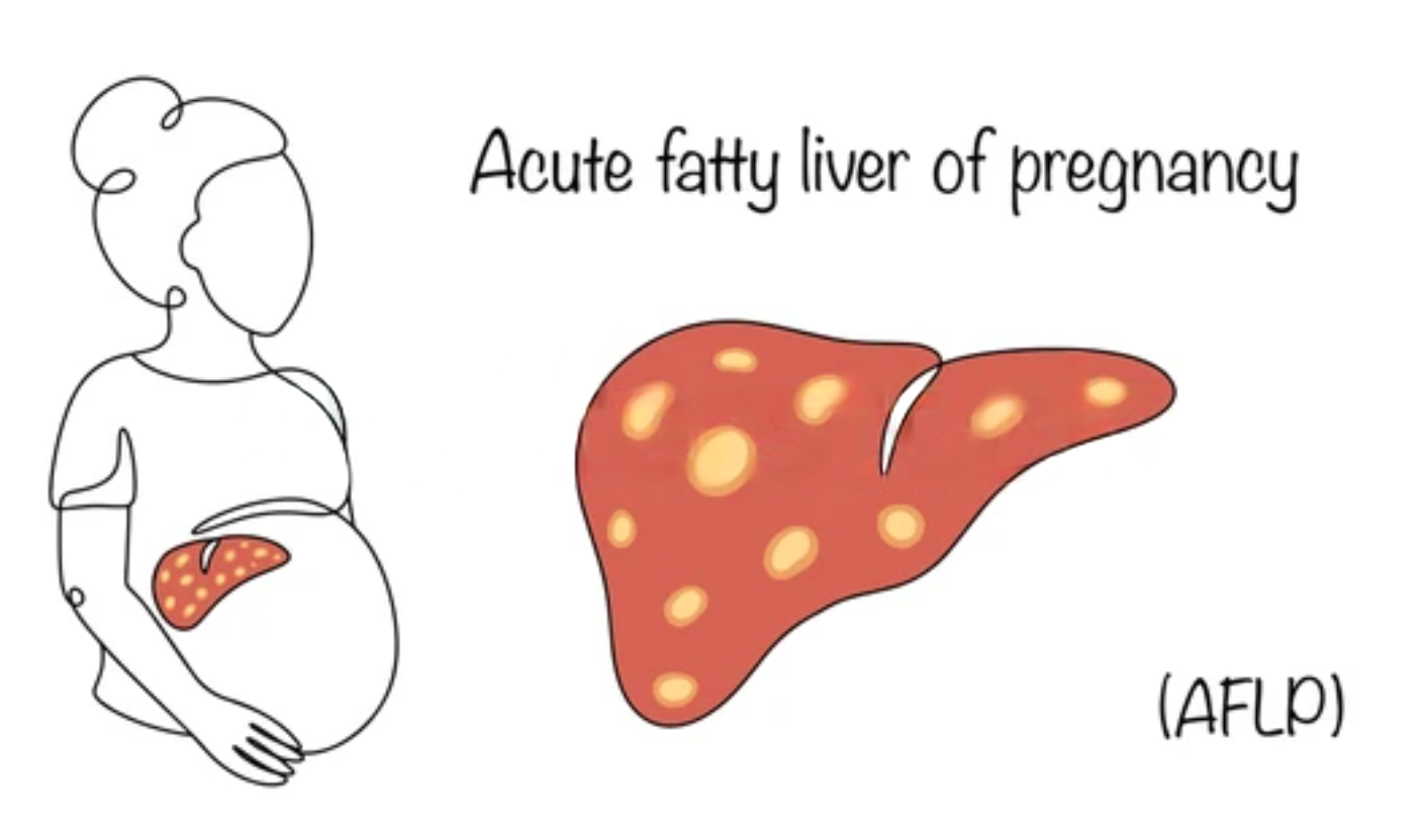 NAFLD- Non-Alcoholic Fatty Liver Disease
