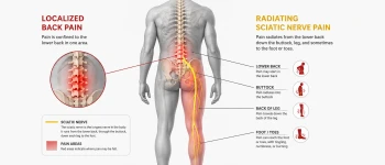 Sciatica vs Back Pain: How to Tell the Difference