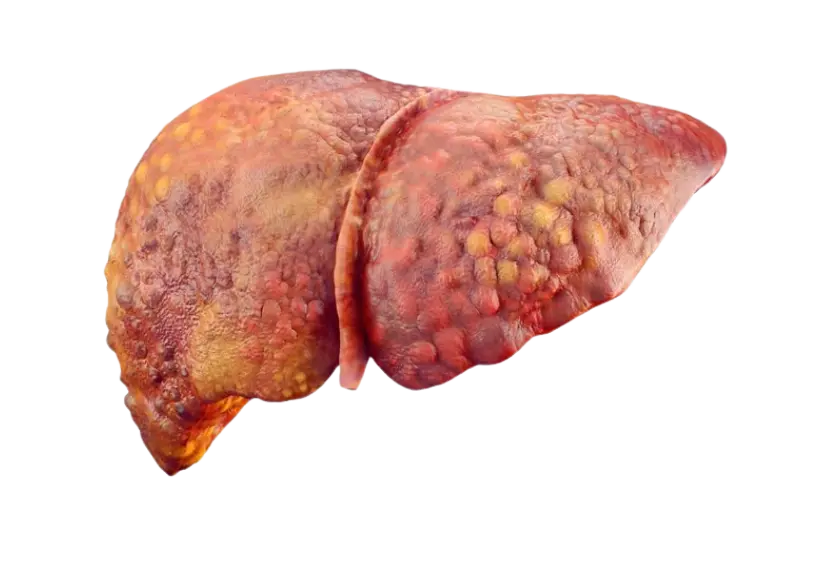 Liver disorder